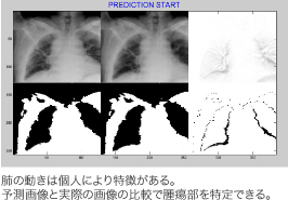 肺の動きは個人により特徴がある。 予測画像と実際の画像の比較で腫瘍部を特定できる。 